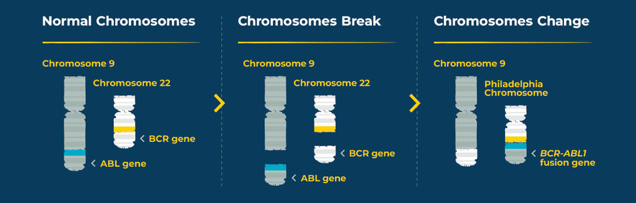 Image showing how a normal chromosome impacted by Ph+ CML break and change in the body